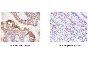 Paraffin embedded sections of human colon and gastric canitrocelluloseer tissue were initrocelluloseubated with anti-human EphA2 (1:100) for 2 hours at room temperature. (EPH Receptor A2 抗体  (AA 559-976))