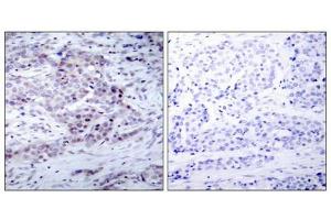 Immunohistochemical analysis of paraffin-embedded human breast carcinoma tissue using NF-κ,B p100(phospho- Ser870) antibody. (NFKB2 抗体  (pSer870))