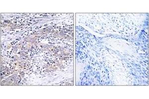 Immunohistochemistry analysis of paraffin-embedded human cervix carcinoma tissue, using CLN6 Antibody. (CLN6 抗体  (AA 221-270))