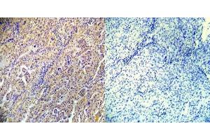 Immunohistochemical analysis of paraffin-embedded human lung carcinoma tissue using AMPKbeta1 (phospho-Ser182) (E012004). (PRKAB1 抗体  (pSer182))
