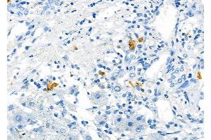 ABIN6266273 and ABIN6277461 at 1/100 staining Human liver cancer and adjacent normal tissues by IHC-P. (SSTR2 抗体  (C-Term))