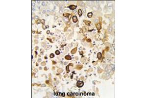 Formalin-fixed and paraffin-embedded human lung carcinoma tissue reacted with CYP4X1 antibody (N-term), which was peroxidase-conjugated to the secondary antibody, followed by DAB staining. (CYP4X1 抗体  (N-Term))
