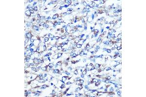 Immunohistochemistry of paraffin-embedded human liver cancer using OPTN Rabbit pAb (ABIN3015612, ABIN3015613, ABIN3015614 and ABIN6218972) at dilution of 1:100 (40x lens). (OPTN 抗体  (AA 1-577))