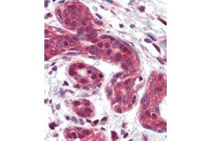 Formalin-fixed and paraffin-embedded human Breast tissue reacted with SLUG Antibody (Center) (ABIN6242822 and ABIN6577392) , which was peroxidase-conjugated to the secondary antibody, followed by AEC staining. (SLUG 抗体  (AA 98-129))