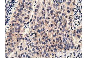 Immunohistochemical staining of paraffin-embedded Carcinoma of Human bladder tissue using anti-PRKD2 mouse monoclonal antibody. (PKD2 抗体)