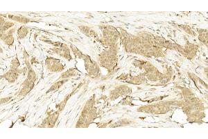Immunohistochemical analysis of paraffin-embedded Human Breast cancer section using Pink1  8417b. (CDK5 抗体)