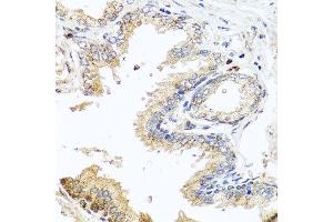 Immunohistochemistry of paraffin-embedded human prostate using MCCC2 antibody at dilution of 1:100 (x40 lens). (MCCC2 抗体)