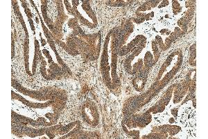 Immunohistochemistry analysis using Rabbit Anti-MDM2 Polyclonal Antibody (ABIN5668003). (MDM2 抗体  (AA 100-200) (Biotin))