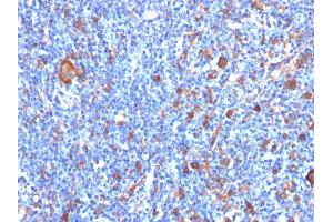 Formalin-fixed, paraffin-embedded human Hodgkin's Lymphoma stained with Fascin-1 Mouse Monoclonal Antibody (FSCN1/417) (Fascin 抗体)