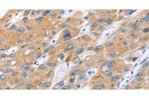 Immunohistochemistry of paraffin-embedded Human liver cancer tissue using ERVW-1 Polyclonal Antibody at dilution 1:45 (ERVW-1 抗体)