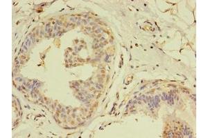 Immunohistochemistry of paraffin-embedded human breast cancer using ABIN7159241 at dilution of 1:100 (MLANA 抗体  (AA 1-118))