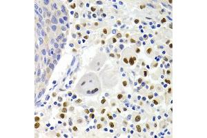 Immunohistochemistry of paraffin-embedded human lung cancer using GEMIN2 Antibody. (SIP1 抗体)