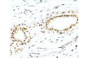 Immunohistochemistry of paraffin-embedded Human breast cancer using XRCC4 Polyclonal Antibody at dilution of 1:100 (40x lens). (XRCC4 抗体)