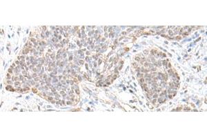 Immunohistochemistry of paraffin-embedded Human esophagus cancer tissue using TCF25 Polyclonal Antibody at dilution of 1:35(x200) (TCF25 抗体)