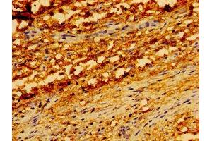Immunohistochemistry of paraffin-embedded human melanoma using ABIN7173904 at dilution of 1: 100 (TRADD 抗体  (AA 1-312))