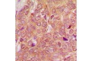 Immunohistochemical analysis of SEN54 staining in human breast cancer formalin fixed paraffin embedded tissue section. (TSEN54 抗体)