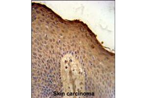 ISM1 Antibody immunohistochemistry analysis in formalin fixed and paraffin embedded human skin carcinoma followed by peroxidase conjugation of the secondary antibody and DAB staining. (ISM1 抗体  (C-Term))