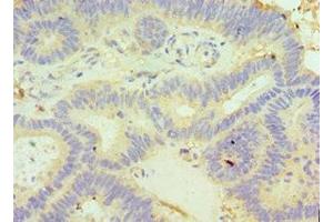 Immunohistochemistry of paraffin-embedded human colon cancer using ABIN7154051 at dilution of 1:100 (GLRX3 抗体  (AA 1-335))