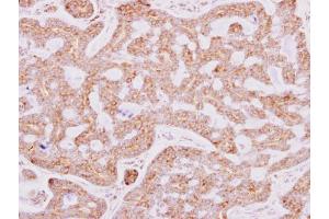 IHC-P Image RPL15 antibody detects RPL15 protein at cytosol on human breast carcinoma by immunohistochemical analysis. (RPL15 抗体)