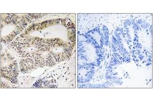 Immunohistochemistry analysis of paraffin-embedded human colon carcinoma tissue, using OSR1 (Ab-185) Antibody. (OSR1 抗体  (AA 151-200))