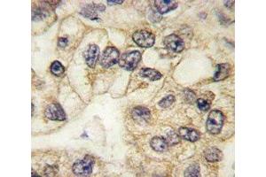 CD14 antibody used to stain FFPE human lung carcinoma (CD14 抗体  (AA 292-322))