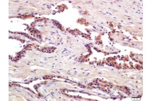 Formalin-fixed and paraffin embedded human prostate cancer labeled with Anti-PRSS8 Polyclonal Antibody, Unconjugated (ABIN761891) at 1:200 followed by conjugation to the secondary antibody and DAB staining (PRSS8 抗体  (AA 65-165))