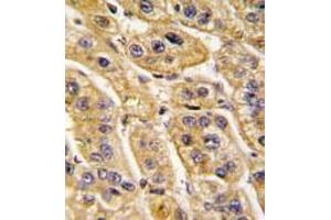 Formalin-fixed and paraffin-embedded human hepatocarcinoma tissue reacted with HIBCH antibody (Center), which was peroxidase-conjugated to the secondary antibody, followed by DAB staining. (HIBCH 抗体  (Middle Region))