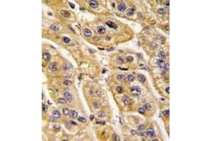 Formalin-fixed and paraffin-embedded human hepatocarcinoma tissue reacted with HIBCH antibody (Center), which was peroxidase-conjugated to the secondary antibody, followed by DAB staining.
