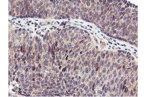 Immunohistochemical staining of paraffin-embedded Carcinoma of Human bladder tissue using anti-RFXANK mouse monoclonal antibody. (RFXANK 抗体)