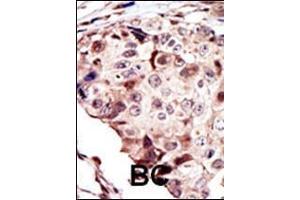Formalin-fixed and paraffin-embedded human cancer tissue reacted with the primary antibody, which was peroxidase-conjugated to the secondary antibody, followed by AEC staining. (RYK 抗体  (AA 160-190))
