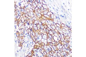 Immunohistochemistry of paraffin-embedded human esophageal cancer using NDRG1 Rabbit mAb (ABIN7268783) at dilution of 1:100 (40x lens). (NDRG1 抗体)