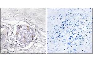 Immunohistochemistry analysis of paraffin-embedded human liver carcinoma tissue, using Progesterone Receptor (Ab-294) Antibody. (Progesterone Receptor 抗体  (AA 261-310))