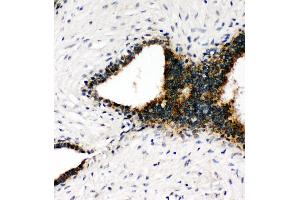 Anti-Annexin VIII antibody, IHC(P) IHC(P): Human Mammary Cancer Tissue (Annexin VII 抗体  (C-Term))