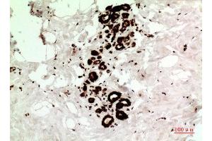 Immunohistochemistry (IHC) analysis of paraffin-embedded Human Breast Cancer, antibody was diluted at 1:100. (HSP70 抗体  (Ser102))