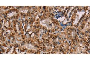 Immunohistochemistry of paraffin-embedded Human thyroid cancer using hnRNP G Polyclonal Antibody at dilution of 1:45 (RBMX 抗体)