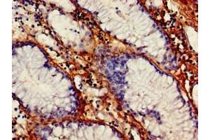 Immunohistochemistry of paraffin-embedded human gastric cancer using ABIN7175368 at dilution of 1:100