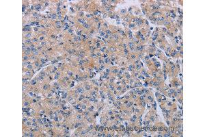 Immunohistochemistry of Human prostate cancer using P2RX3 Polyclonal Antibody at dilution of 1:50