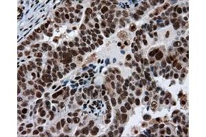 Immunohistochemical staining of paraffin-embedded Adenocarcinoma of breast tissue using anti-ACLY mouse monoclonal antibody. (ACLY 抗体)