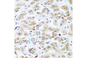 Immunohistochemistry of paraffin-embedded human liver cancer using KIAA1456 antibody (ABIN5974326) at dilution of 1/200 (40x lens). (KIAA1456 抗体)