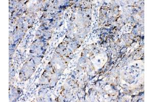 IHC testing of FFPE human lung cancer tissue with Bax antibody at 1ug/ml. (BAX 抗体  (AA 17-48))