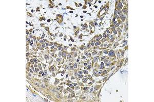Immunohistochemistry of paraffin-embedded human skin carcinoma using ICOSL Antibody (ABIN6130065, ABIN6142131, ABIN6142132 and ABIN6222879) at dilution of 1:100 (40x lens). (ICOSLG 抗体  (AA 19-256))