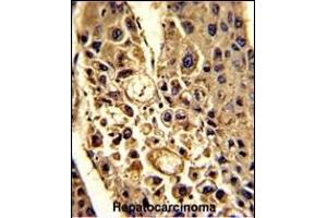 Formalin-fixed and paraffin-embedded human hepatocarcinoma with CFHL1 Antibody (C-term), which was peroxidase-conjugated to the secondary antibody, followed by DAB staining. (CFHR1 抗体  (C-Term))