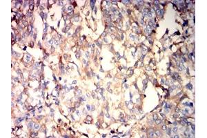 Immunohistochemical analysis of paraffin-embedded bladder cancer tissues using ALB mouse mAb with DAB staining. (Albumin 抗体  (AA 410-609))