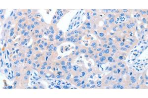 Immunohistochemistry of paraffin-embedded Human lung cancer tissue using NUAK1 Polyclonal Antibody at dilution 1:60 (NUAK1 抗体)