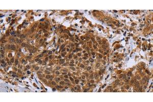 Immunohistochemistry of paraffin-embedded Human cervical cancer using DUSP8 Polyclonal Antibody at dilution of 1:30 (DUSP8 抗体)