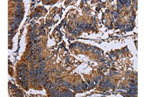 The image on the left is immunohistochemistry of paraffin-embedded Human colon cancer tissue using ABIN7130044(KRT31 Antibody) at dilution 1/30, on the right is treated with fusion protein. (Keratin 31 抗体)