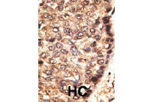 Formalin-fixed and paraffin-embedded human hepatocellular carcinoma tissue reacted with MMP24 polyclonal antibody  , which was peroxidase-conjugated to the secondary antibody, followed by AEC staining.