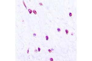 Immunohistochemical analysis of CDC25C (pS216) staining in human lung cancer formalin fixed paraffin embedded tissue section. (CDC25C 抗体  (pSer216))