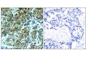 Immunohistochemical analysis of paraffin-embedded human breast carcinoma tissue, using Cortactin (Ab-466) antibody (E021264). (Cortactin 抗体)