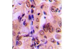 Immunohistochemical analysis of MKK1 (pT292) staining in human breast cancer formalin fixed paraffin embedded tissue section.